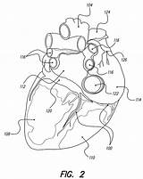 Patents Coronary Artery sketch template