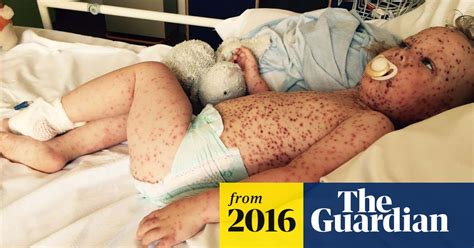 Worst Case Of Chickenpox Sparks Call For Rethink On Vaccination