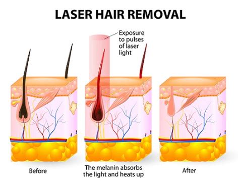 Laser Hair Removal Vector Diagram Paradise Med Spa