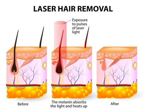 laser hair removal work women health info blog