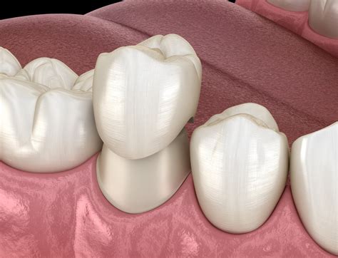 dental crown   damaged tooth shinagawa dental blog