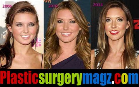Audrina Patridge Plastic Surgery Before And After Photos