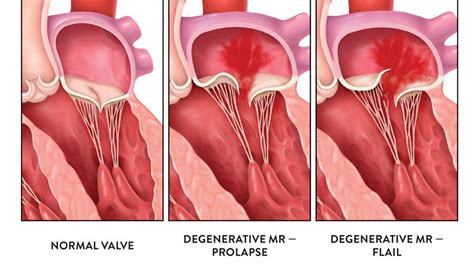Minimally Invasive Heart Valve Procedure From Virginia
