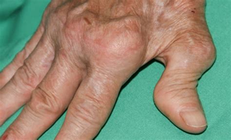 rheumatoid arthritis latest diagnosis  management approaches