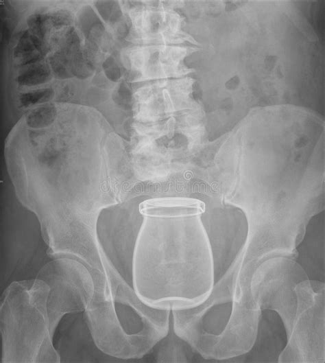 X Ray Of Pelvis With Glass Inserted In Rectum Stock Image