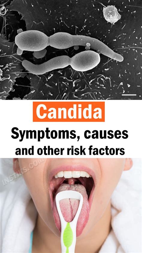 Candida – Symptoms Causes And Other Risk Factors Candida Symptoms