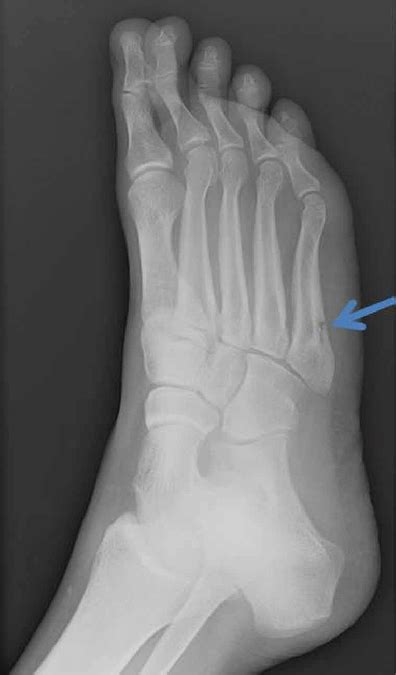 Plain Radiograph Shows Fifth Metatarsal Stress Fracture Blue Arrow