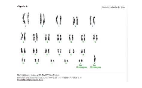 File Karyogram Of Male With 47 Xyy Syndrome Png Embryology