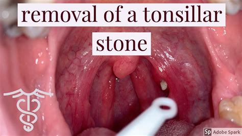 remove tonsil stones video howotremvo