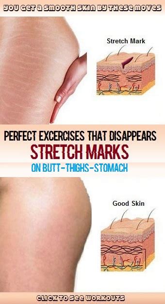stretch marks on ass porn clips