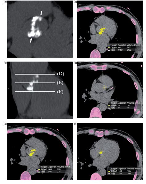 Figure 1 From Association Between Aortic Valvular Calcification And