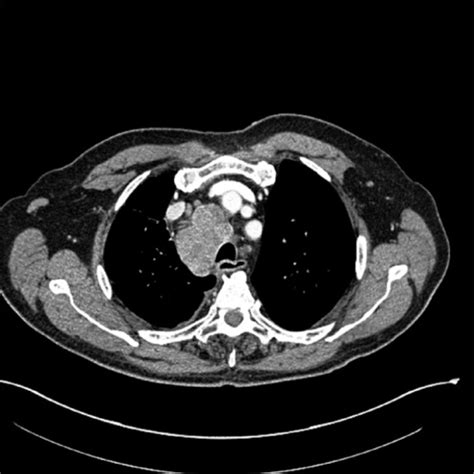 Figure 1 Two Smalls In One Coincident Small Cell Carcinoma And Small