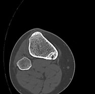 Bildergebnis für Osteoidosteom der Tibia. Größe: 188 x 185. Quelle: pacs.de
