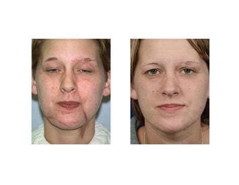 facial reconstructive surgery scars porn pics and moveis