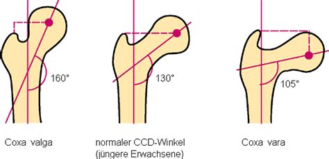 abbildung zu coxa vara