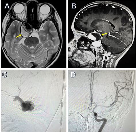 cureus microsurgical treatment   giant intracavernous carotid