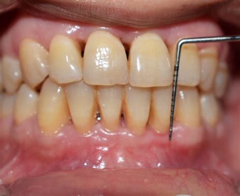 increasing width  attached gingiva