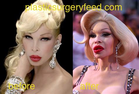 Amanda Lepore Plastic Surgery Plastic Surgery Feed