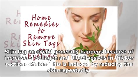 5 exceptional home remedies to remove skin tags on eyelids