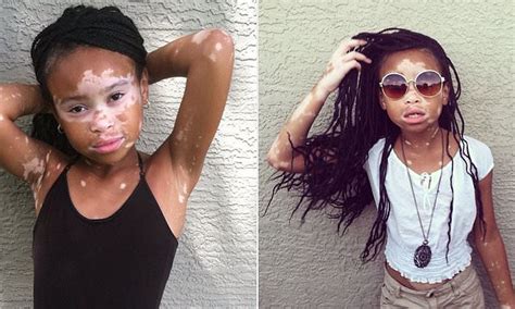 April Star With Vitiligo Who Wants To Be A Model Overcomes Taunts Of