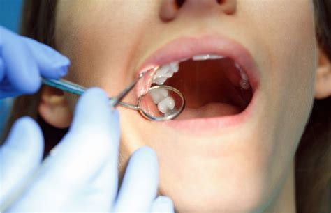 The Dos And Don’ts Of Aftercare Wisdom Tooth Extraction