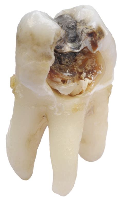 cavity loveland dentist ross family dentistry anne ross dds implants crowns bridges