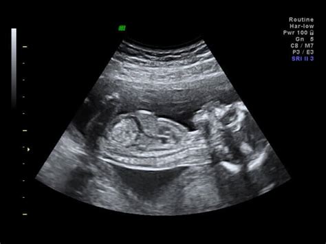 Private Early Pregnancy Scans Explained Ultrasound Plus