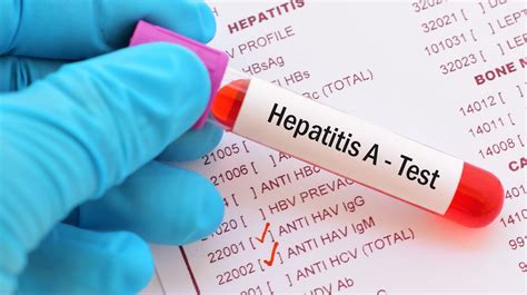 hepatitis a outbreaks in ohio ky what diners should know