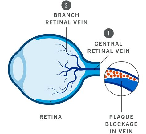 genentech understanding retinal vein occlusion