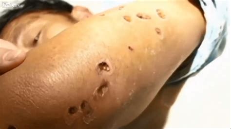 Giant Asian Hornets Leaves Victims With Gaping Holes