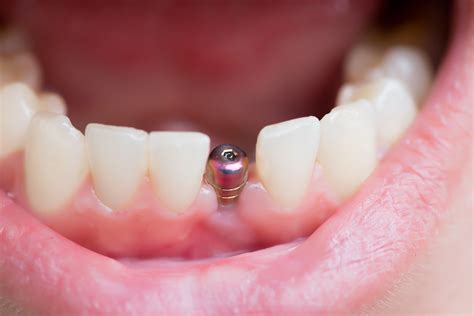 benefits  single tooth dental implants bc perio dental health