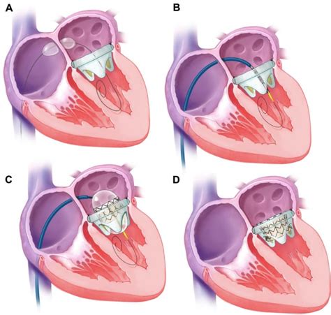 Aubmc Performs The First Transseptal Percutaneous Mitral Valve In Valve