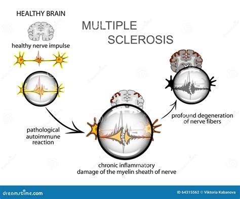 multiple sclerosis neurology stock vector image