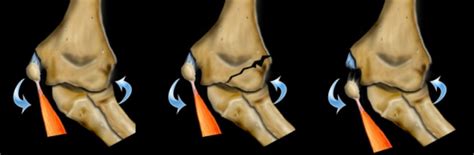 Pediatric Humeral Fracture Physiopedia