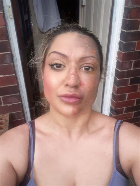 Mum Left With Skin Peeling Off Her Face After Egg Exploded During