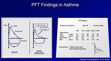 pft  asthma flow volume loops dr eric strong grepmed