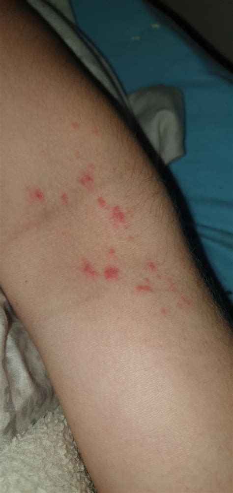 Can Anyone Help Identify This Itchy Rash 22 Year Old Male On The