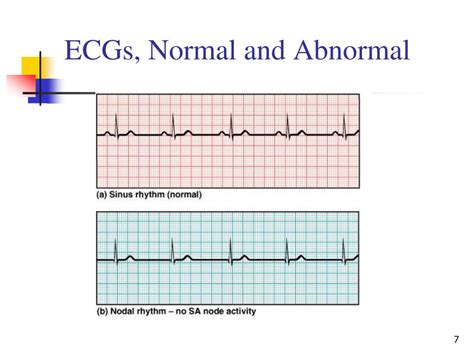 electrocardiography abnormalities arrhythmias  powerpoint