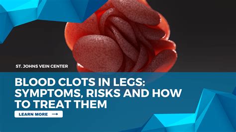 blood clots  legs symptoms risks    treat  st johns