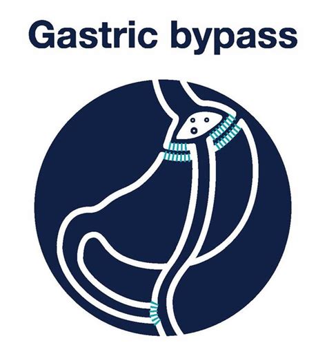Bariatric Surgery Laparoscopic Gastric Bypass