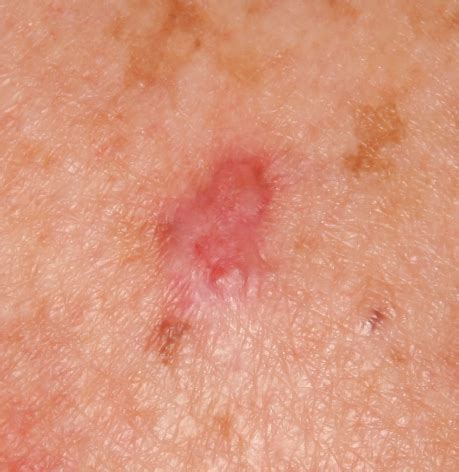 skin lesion pictures pictures