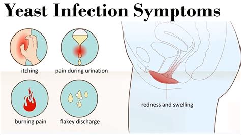 Yeast Infection Symptoms How You Can Diagnose The Severe Yeast