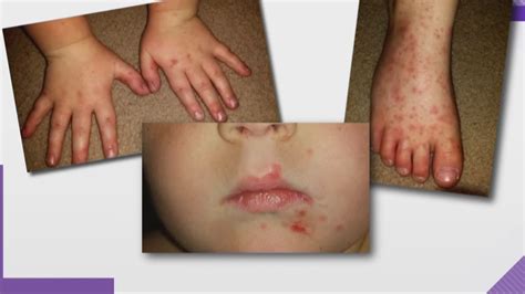 cases of hand foot mouth disease on the rise in the carolinas