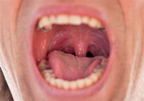 swollen uvula causes symptoms and remedies