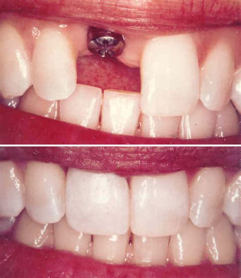 single tooth implant carmel  smiles   village dentistry