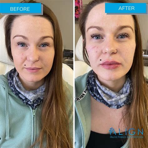 Before And After Before And After Cheek Filler Align Injectable