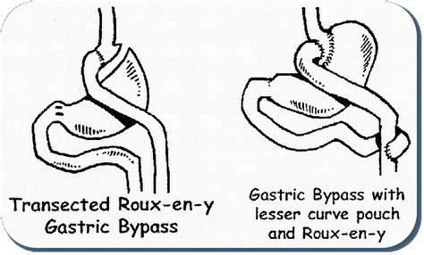 Roux En Y Gastric Bypass Rny Weight Loss Surgery