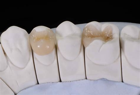 inlays  onlays whats  difference kate brayman dds