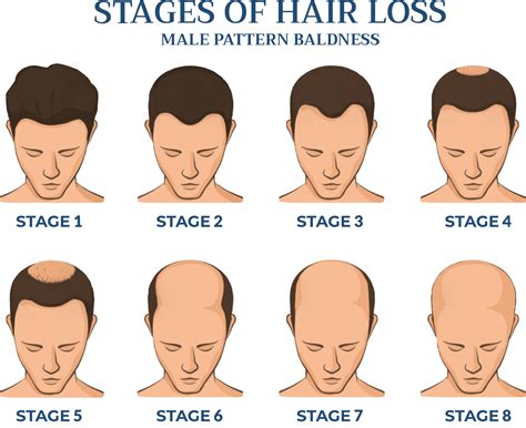 hair loss  men male hair loss cranial prosthesis center