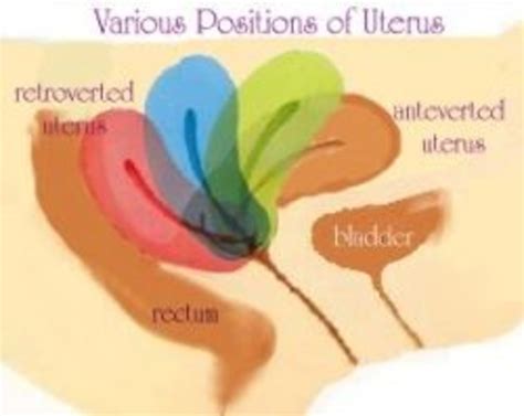 Tilted Uterus And Early Pregnancy Hubpages